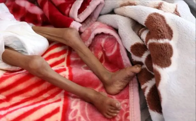 تظهر في الصورة قدما طفلة لونهما أسمر ونحيلتان جداً.
